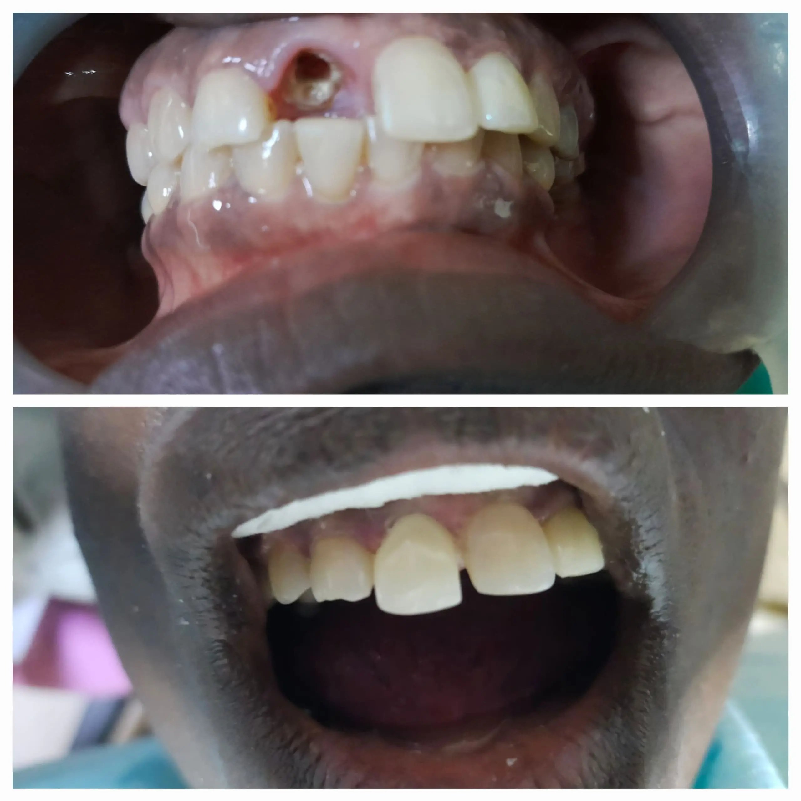 Crown Treatment done at Sterling Dental Clinic
